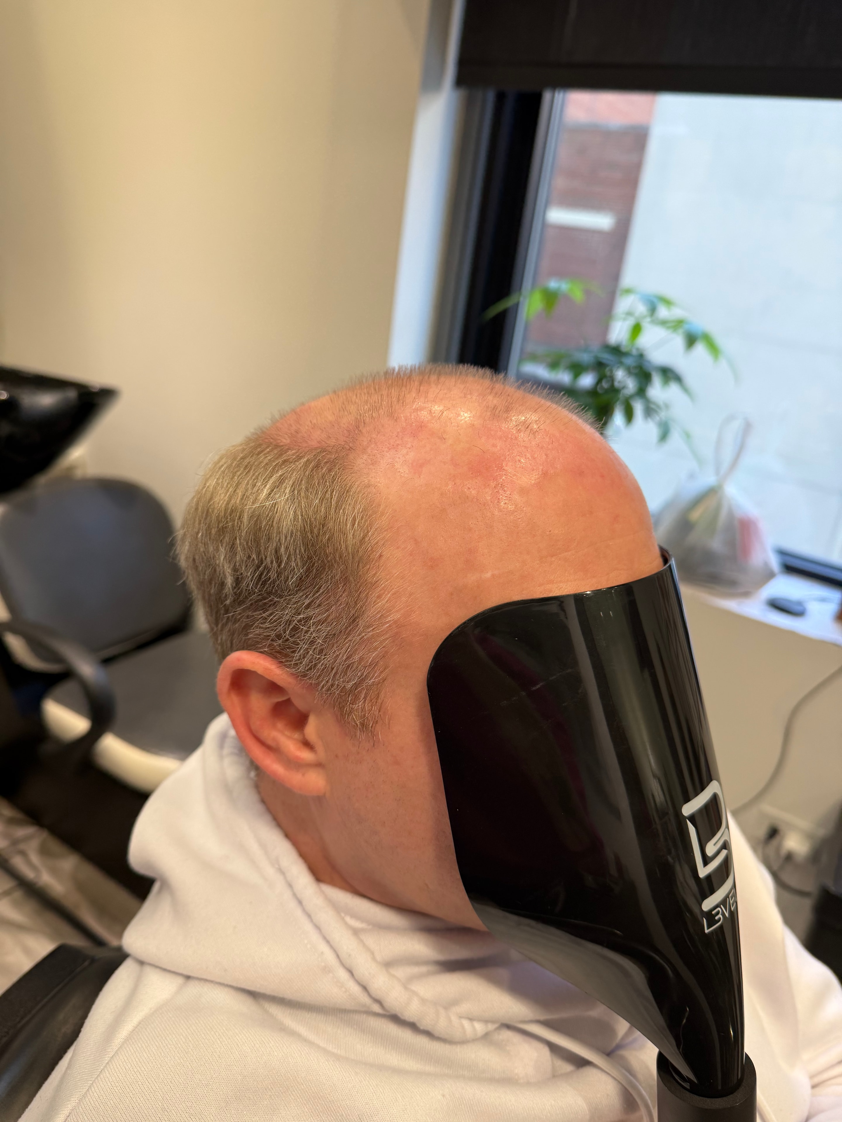 Hair replacement transformation result
